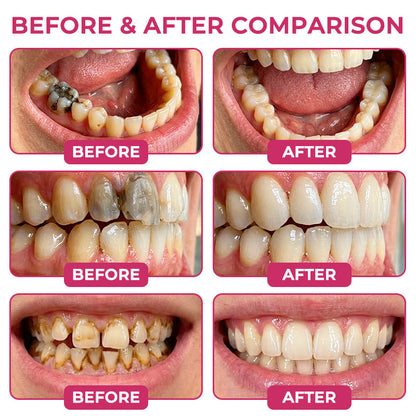 💥100K+ SOLD💕 - COUGEX® Cavity-Repair Natural Enamel Filling Gel